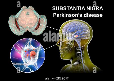 La substantia nigra. Illustration de l'ordinateur un dégénéré substantia nigra dans la maladie de Parkinson. La substantia nigra joue un rôle important dans Banque D'Images