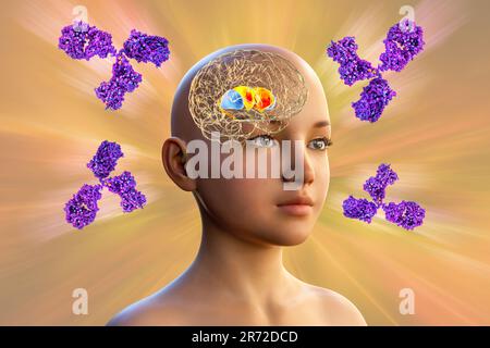 Anticorps anti-ganglionnaires basaux (ABGA). Illustration informatique conceptuelle montrant des molécules d'immunoglobulines attaquant le striatum dorsal mis en évidence dans t Banque D'Images