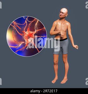 Personne atteinte de la maladie de chorée et vue rapprochée de la dégradation neuronale qui résulte de mouvements de choreiform, illustration informatique conceptuelle. Banque D'Images