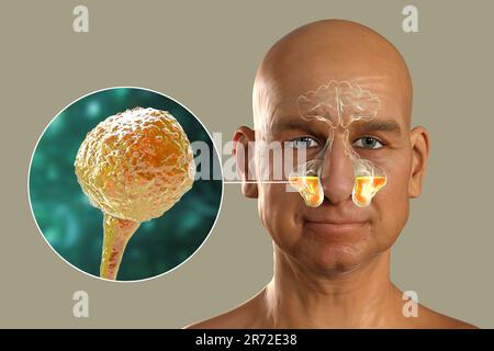 Champignons de Mucor comme cause de sinusite, illustration informatique. Inflammation des sinus maxillaires et vue rapprochée des champignons Mucor, également connu sous le nom de fu noir Banque D'Images