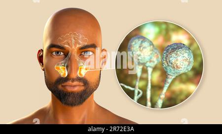 Champignons de Mucor comme cause de sinusite, illustration informatique. Inflammation des sinus maxillaires et vue rapprochée des champignons Mucor, également connu sous le nom de fu noir Banque D'Images
