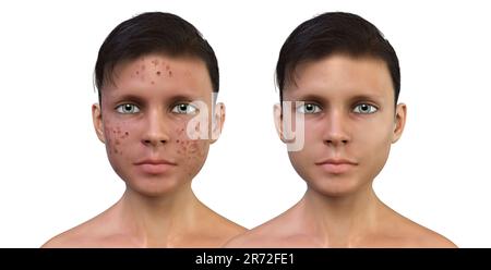 Acné vulgaris sur le visage d'un adolescent, illustration d'ordinateur montrant la peau du garçon avant et après le traitement. L'acné est un nom général donné à une peau Banque D'Images