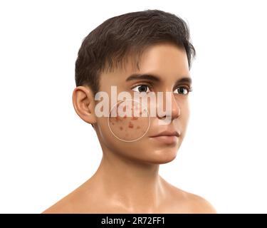 Acné vulgaris sur le visage d'un adolescent, illustration d'ordinateur montrant la peau du garçon avant et après le traitement. L'acné est un nom général donné à une peau Banque D'Images