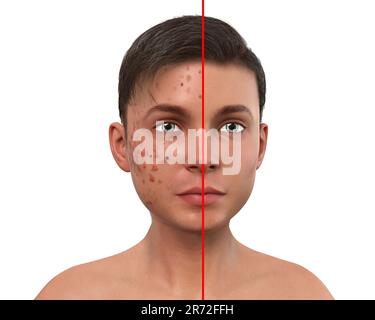 Acné vulgaris sur le visage d'un adolescent, illustration d'ordinateur montrant la peau du garçon avant et après le traitement. L'acné est un nom général donné à une peau Banque D'Images