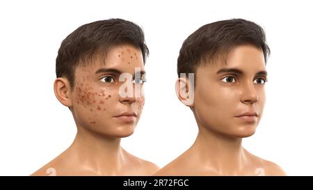 Acné vulgaris sur le visage d'un adolescent, illustration d'ordinateur montrant la peau du garçon avant et après le traitement. L'acné est un nom général donné à une peau Banque D'Images