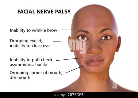 Paralysie de Bell, paralysie faciale unilatérale, illustration informatique. La condition est due à l'inflammation du nerf facial. Il provoque le dro facial Banque D'Images