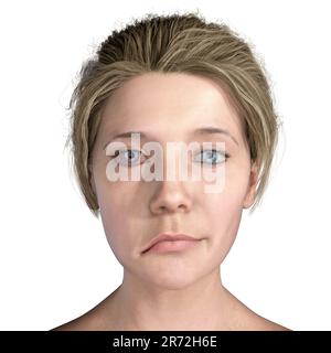 Paralysie de Bell, paralysie faciale unilatérale, illustration informatique. La condition est due à l'inflammation du nerf facial. Il provoque le dro facial Banque D'Images