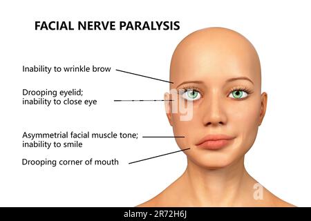 Paralysie de Bell, paralysie faciale unilatérale, illustration informatique. La condition est due à l'inflammation du nerf facial. Il provoque le dro facial Banque D'Images