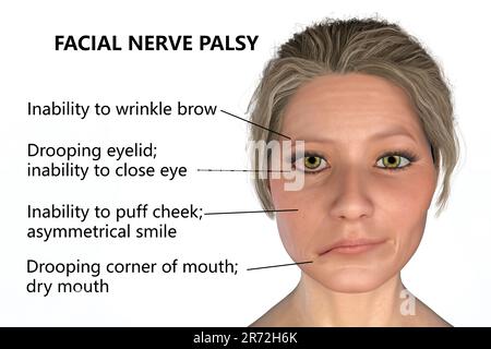 Paralysie de Bell, paralysie faciale unilatérale, illustration informatique. La condition est due à l'inflammation du nerf facial. Il provoque le dro facial Banque D'Images