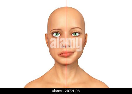 Paralysie de Bell, paralysie faciale unilatérale, illustration informatique. La condition est due à l'inflammation du nerf facial. Il provoque le dro facial Banque D'Images