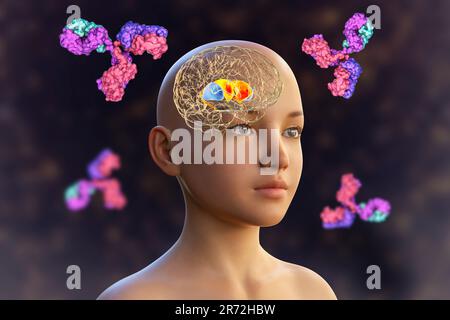 Anticorps anti-ganglionnaires basaux (ABGA). Illustration informatique conceptuelle montrant des molécules d'immunoglobulines attaquant le striatum dorsal mis en évidence dans t Banque D'Images