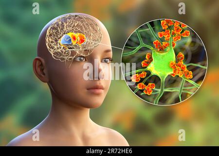 Anticorps anti-ganglionnaires basaux (ABGA). Illustration informatique conceptuelle montrant des molécules d'immunoglobulines attaquant le striatum dorsal mis en évidence dans t Banque D'Images