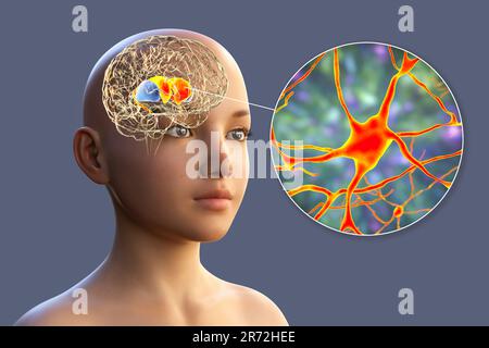 Striatum dorsal mis en évidence dans le cerveau de l'enfant et vue rapprochée de ses neurones, illustration informatique. C'est un noyau dans les ganglions basaux, un composant Banque D'Images