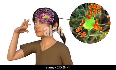 Anticorps anti-ganglionnaires basaux (ABGA). Illustration informatique conceptuelle montrant des molécules d'immunoglobulines attaquant le striatum dorsal mis en évidence dans t Banque D'Images