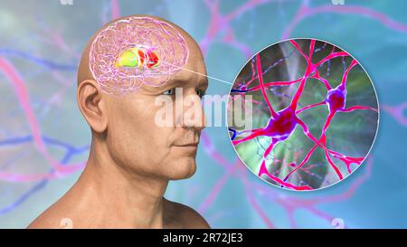 Striatum dorsal mis en évidence dans le cerveau humain et vue rapprochée de ses neurones, illustration informatique. C'est un noyau dans les ganglions basaux, un composant Banque D'Images