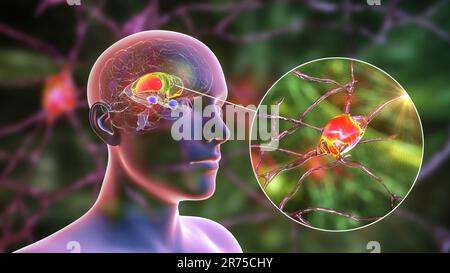 Striatum dorsal mis en évidence dans le cerveau humain et vue rapprochée de ses neurones, illustration informatique. C'est un noyau dans les ganglions basaux, un composant Banque D'Images