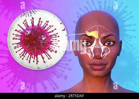 Sinusite virale, illustration informatique. La sinusite, également connue sous le nom d'infection sinusale ou rhinosinusite, est une inflammation des sinus qui entraîne une symp Banque D'Images