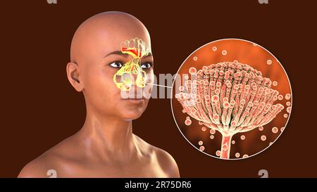 Aspergillus champignons comme une cause de sinusite. Illustration informatique montrant une inflammation des sinus frontaux, ethmoïdes et maxillaires, et vue rapprochée de Banque D'Images