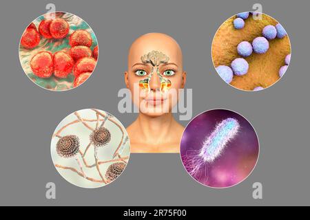 Anatomie de la rhinosinusite et des micro-organismes qui causent la sinusite. Streptococcus pneumoniae, Streptococcus mutans, Aspergillus fumigatus et Pseudomo Banque D'Images