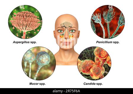 Les champignons comme cause de sinusite. Illustration informatique montrant l'inflammation des sinus maxillaires et des champignons Aspergillus, Penicillium, Mucor et Candida. Banque D'Images