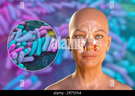 Sinusite bactérienne, illustration informatique. Les sinus sont des espaces remplis d'air et bordés de membrane dans les os du visage. Les sinus frontaux sont au-dessus de t Banque D'Images