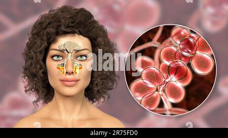 Les champignons de Candida comme cause de sinusite. Illustration informatique montrant l'inflammation des sinus maxillaires et vue rapprochée des levures de Candida. Banque D'Images