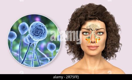 Les champignons de Mucor moule comme une cause de sinusite. Illustration informatique montrant l'inflammation des sinus maxillaires et vue rapprochée des champignons de Mucor, également connue Banque D'Images