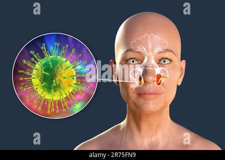 Sinusite virale, illustration informatique. La sinusite, également connue sous le nom d'infection sinusale ou rhinosinusite, est une inflammation des sinus qui entraîne une symp Banque D'Images