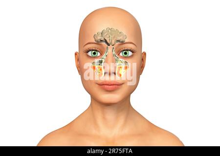 Infection sinusale, ou sinusite, illustration informatique. Les sinus sont des espaces remplis d'air et bordés de membrane dans les os du visage. Les sinus frontaux a Banque D'Images