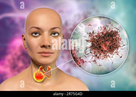 Cancer de la glande thyroïde avec vue rapprochée des cellules cancéreuses, illustration informatique. Banque D'Images
