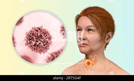 Cancer de la glande thyroïde avec vue rapprochée des cellules cancéreuses, illustration informatique. Banque D'Images