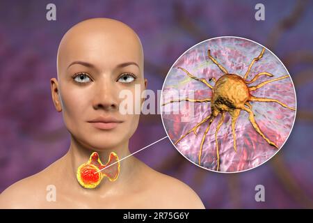 Cancer de la glande thyroïde avec vue rapprochée des cellules cancéreuses, illustration informatique. Banque D'Images