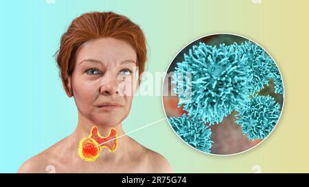 Cancer de la glande thyroïde avec vue rapprochée des cellules cancéreuses, illustration informatique. Banque D'Images