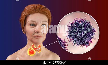 Cancer de la glande thyroïde avec vue rapprochée des cellules cancéreuses, illustration informatique. Banque D'Images