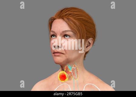 Tumeur de la glande thyroïde, illustration de l'ordinateur. Banque D'Images