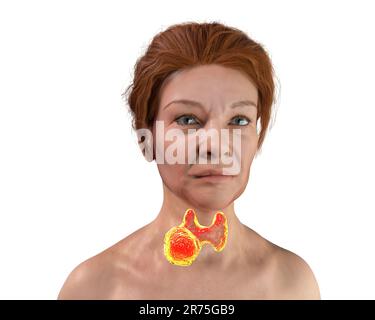 Tumeur de la glande thyroïde, illustration de l'ordinateur. Banque D'Images