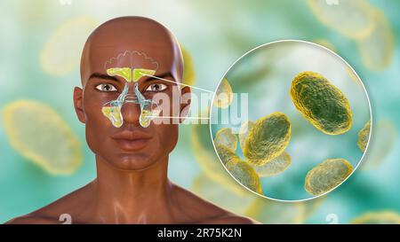 Sinusite bactérienne, illustration informatique. Les sinus sont des espaces remplis d'air et bordés de membrane dans les os du visage. Sinusite, également connue sous le nom de sinu Banque D'Images