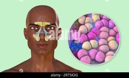 Sinusite bactérienne, illustration informatique. Les sinus sont des espaces remplis d'air et bordés de membrane dans les os du visage. Sinusite, également connue sous le nom de sinu Banque D'Images