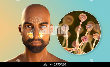 Aspergillus champignons comme une cause de sinusite. Illustration informatique montrant l'inflammation des sinus maxillaires et vue rapprochée du champignon Aspergillus. C Banque D'Images