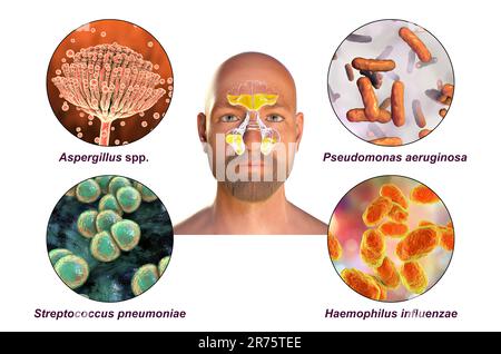 Rhinosinusite et micro-organismes responsables de la sinusite, champignons Aspergillus, bactéries Pseudomonas aeruginosa, Streptococcus pneumoniae et Haemophilus Banque D'Images