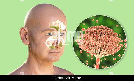Aspergillus champignons comme une cause de sinusite. Illustration informatique montrant l'inflammation des sinus frontaux et maxillaires et vue rapprochée de l'Aspergill Banque D'Images