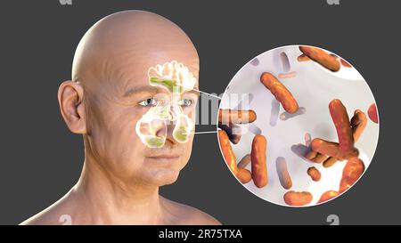 Pseudomonas aeruginosa comme cause de sinusite. Illustration informatique montrant une inflammation purulente des sinus frontaux et maxillaires et du clos Banque D'Images