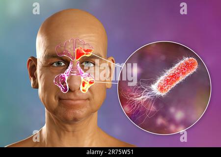 Pseudomonas aeruginosa comme cause de sinusite. Illustration informatique montrant une inflammation purulente des sinus frontaux et maxillaires et du clos Banque D'Images