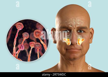 Aspergillus champignons comme une cause de sinusite. Illustration informatique montrant l'inflammation des sinus maxillaires et vue rapprochée du champignon Aspergillus. C Banque D'Images