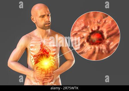 Douleur dans l'estomac, illustration informatique conceptuelle. Un homme souffrant d'un ulcère de l'estomac avec des organes internes mis en évidence et une vue rapprochée de l'ulcère peptique. Banque D'Images