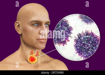 Cancer de la glande thyroïde avec vue rapprochée des cellules cancéreuses, illustration informatique. Banque D'Images