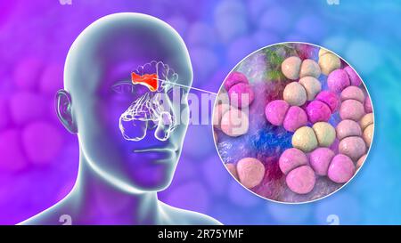 Sinusite bactérienne, illustration informatique. Les sinus sont des espaces remplis d'air et bordés de membrane dans les os du visage. Les sinus frontaux sont au-dessus de t Banque D'Images