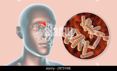 Sinusite bactérienne, illustration informatique. Les sinus sont des espaces remplis d'air et bordés de membrane dans les os du visage. Les sinus frontaux sont au-dessus de t Banque D'Images