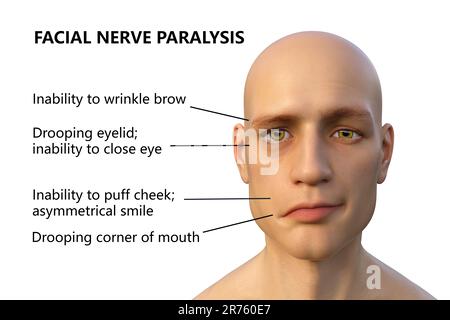 Paralysie de Bell, paralysie faciale unilatérale, illustration informatique. La condition est due à l'inflammation du nerf facial. Il provoque le dro facial Banque D'Images