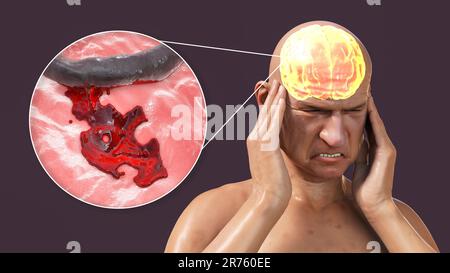 AVC hémorragique, illustration informatique montrant une personne avec un vaisseau sanguin cérébral rompu. Banque D'Images